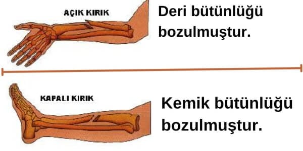 Bir kazazedede deri bütünlüğü bozulmuş ve kırık uçları GÖRÜNÜYORSA aşağıdaki kırık türlerinden hangisi oluşmuştur?